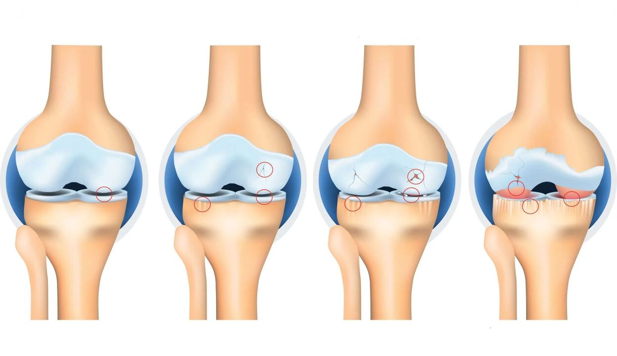 arthrosis ti awọn isẹpo